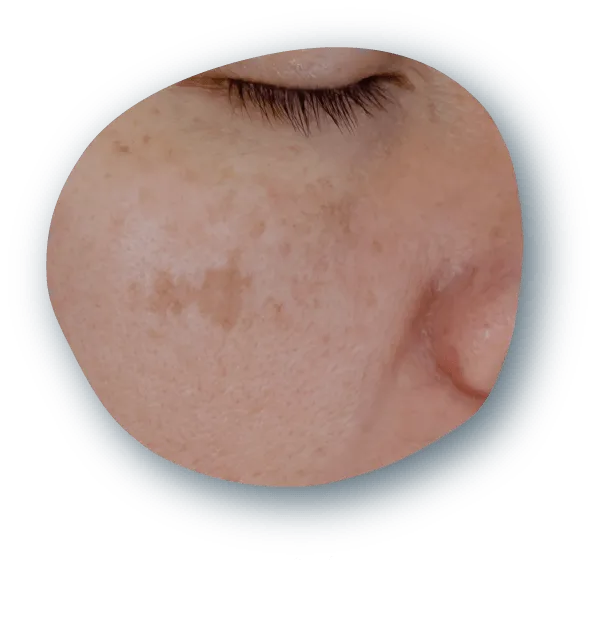 毛穴2